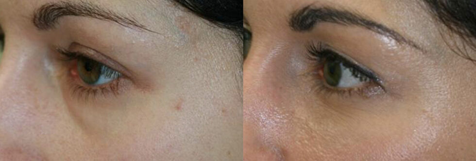 Under Eye Filler: Get Rid of Dark Circles & Tear Troughs Hollows | RSMD ...